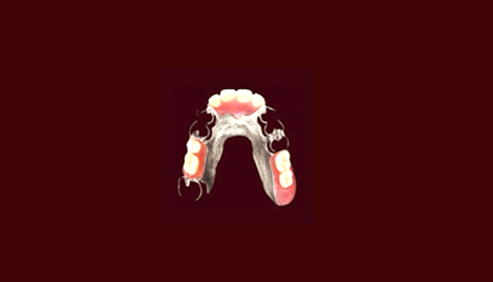 コバルトクロム床義歯の画像